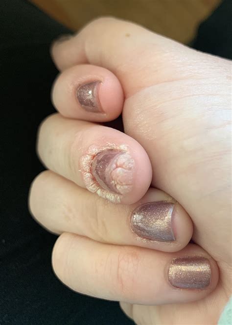 What the heck is wrong with my finger and how do I get rid of this? : Warts