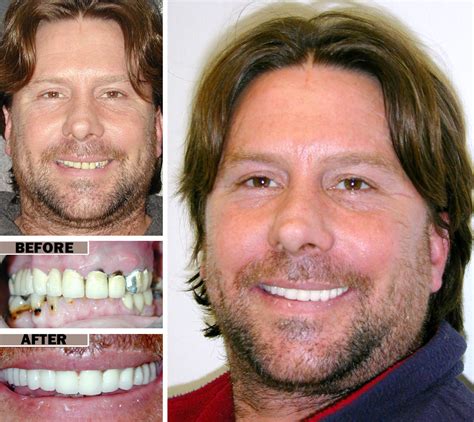 Teeth Surgery Before And After