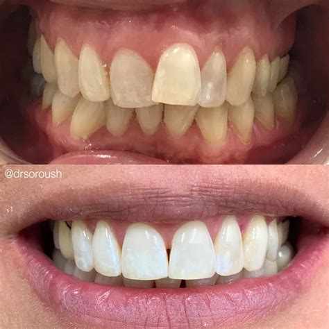 invisalign clear aligners maple ridge maple ridge orthodontics
