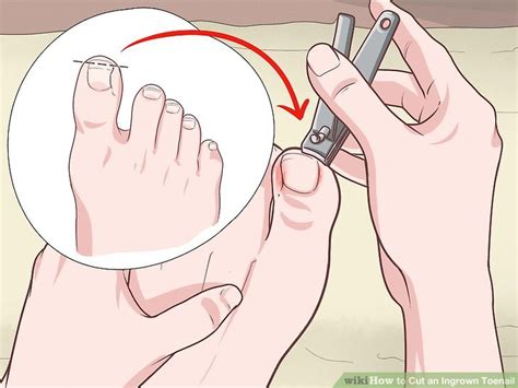 3 Ways to Cut an Ingrown Toenail
