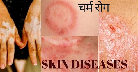 सोरायसिस, मुँहांसे व अन्य चर्म रोग - कारण एवं उपचार | Psoriasis, Acne ...