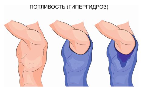 Гипергидроз (повышенная потливость) - лечение сильного потоотделения ...