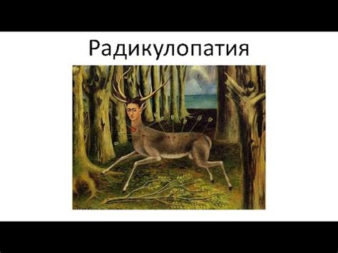Радикулопатия - YouTube
