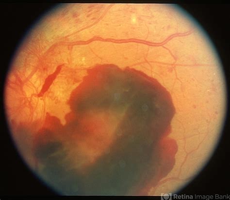 Retinal Neovascularization - Retina Image Bank
