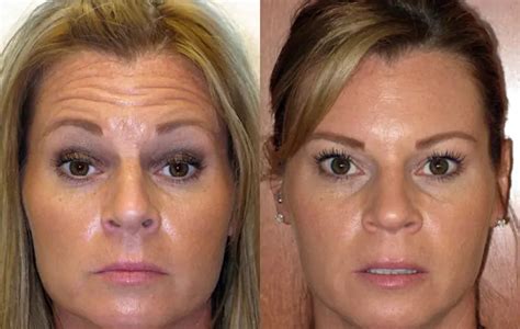 Valor Botox Testa E Olhos - Botox - Tratamento para Rugas na Testa, Glabela e Ao Redor dos Olhos