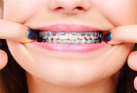 Colorful Braces Make More Than a Fashion Statement | Dr. Blaine ...