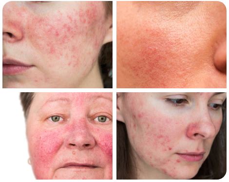 Understanding Rosacea: Causes, Symptoms, and Management – Dr. Base