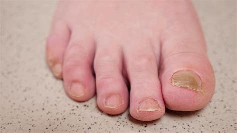 Identifying Toenail Fungus and What to Do About It - ApexFoot.com