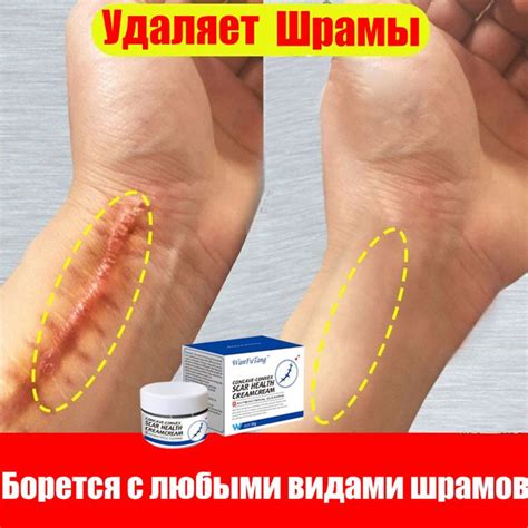 kрем для удаления шрамов, Устранение растяжек 30г против рубцов, шрамов ...