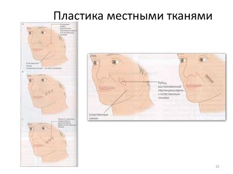 Кожная пластика по Лимбергу - презентация онлайн