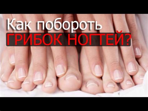 как лечить грибок ногтей перекисью водорода - uniformcustomize