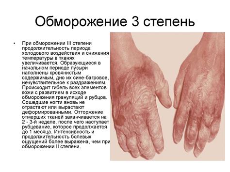 Обморожения - online presentation