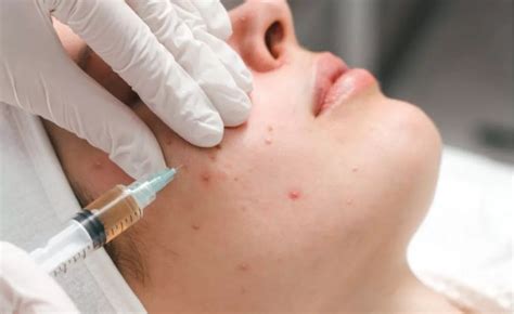PRP Facial Recovery: Essential PRP Aftercare Tips and Timeline