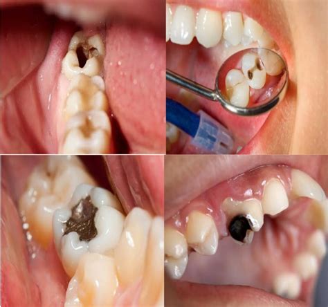 Simple Tips About How To Treat Cavity - Datefaith21