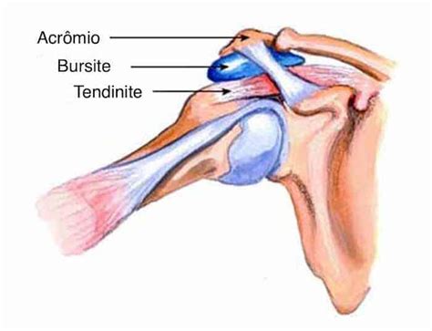 O Que Bursite No Ombro - Bursite: O que é? Causas, sintomas e tratamentos | Clínica Dr. Hong Jin ...