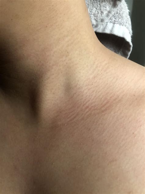 Bumpy Neck Skin Can Someone Tell Me If What Skin Condition Is This? I