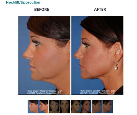 dr william portuese seattle plastic surgeon neck lift surgery