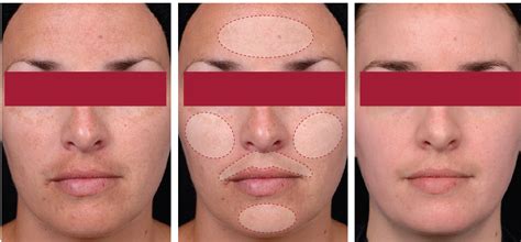 KEMIKUM – Pilingas – Biorevitalizantas. Mokymai Profesionalams - Skinstars