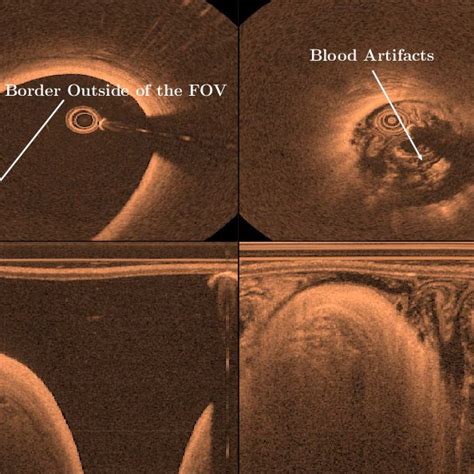 Example IVOCT images, highlighting the difficult nature of the ...