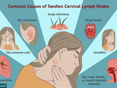 How To Drain Swollen Throat Glands - Best Drain Photos Primagem.Org