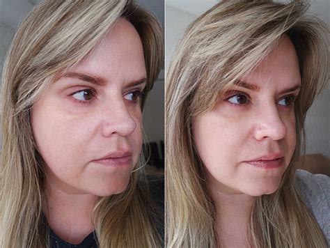 Ultraformer Antes E Depois