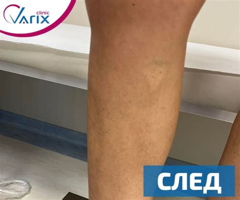 Ендовенозна лазерна аблация и склеротерапия с пяна и добавена реалност