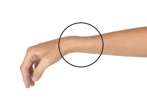 Colles Fracture Treatment
