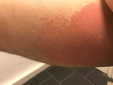 Rash inside upper leg : r/DiagnoseMe