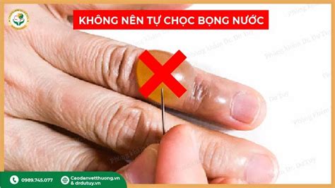 bong phong nuoc  nen choc khong cach xu ly dung tranh nhiem trung