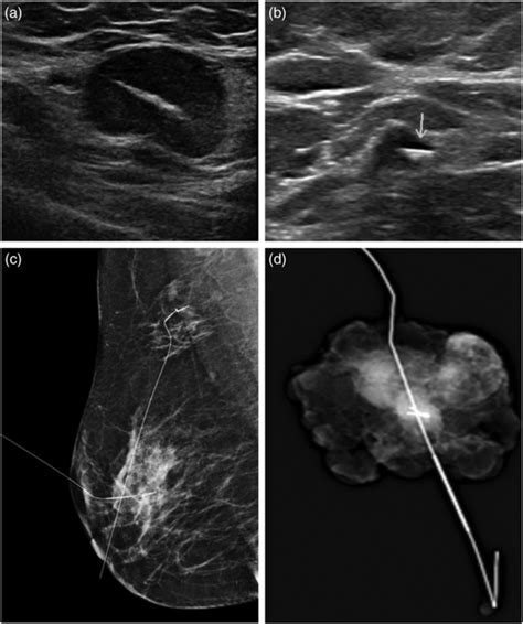 Targeted axillary dissection after neoadjuvant systemic therapy in