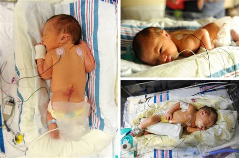 The blessings that come with having a child with spina bifida | by ...
