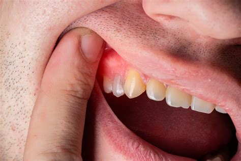 Swollen Gum Around One Tooth: Cause and Treatment Options