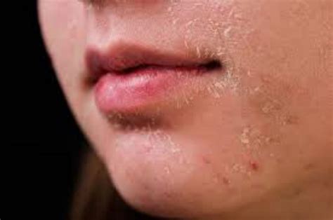 tips mudah mengatasi kulit mengelupas  kering sukoharjonewscom