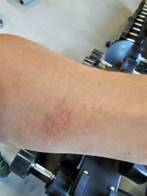 I get wicked bad blood vessels bursting on forearms with deadlifts