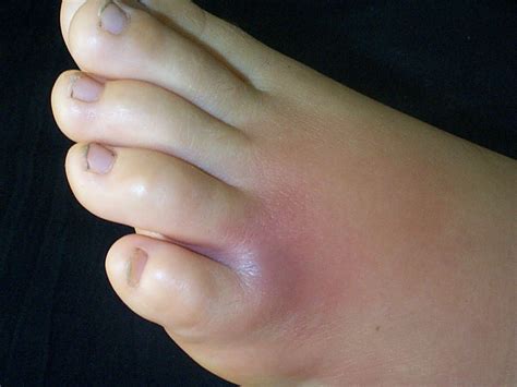 Bite On Bottom Of Foot Outlet | emergencydentistry.com