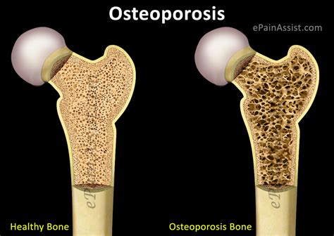Osteoporosis: Treatment, Home Remedies, Prevention, Causes