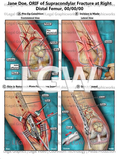ORIF of Supracondylar Fracture at Right Distal Femur – LGWgo