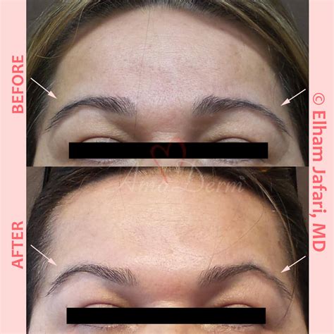 forehead lines common concerns