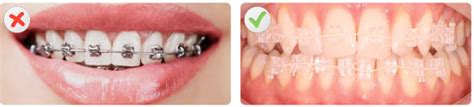 Quick Straight Teeth – WS4 Dental Care