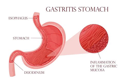 Detailed illustration inflammation in stomach 17214613 Vector Art at ...