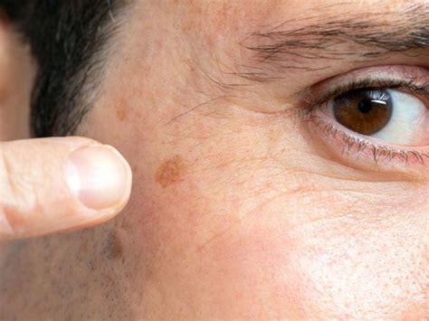 Light Spots On Darker Skin - Infoupdate.org
