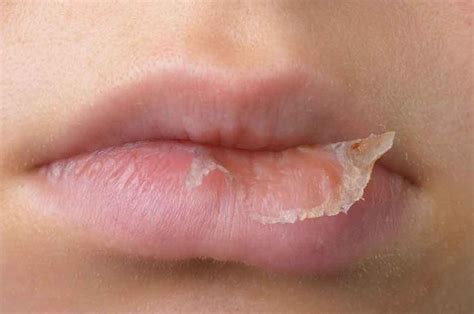 penyebab umum bibir kering haluan lifestyle