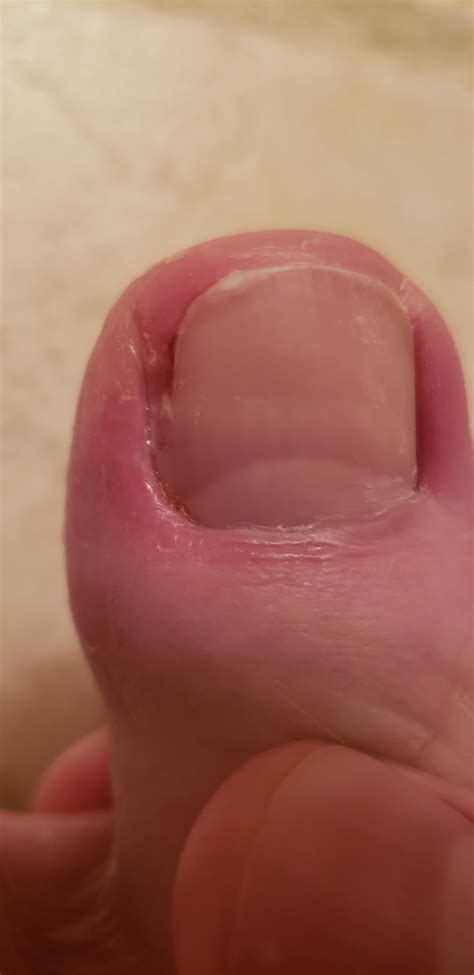 I really messed up cutting my toenail and messed up the side really bad