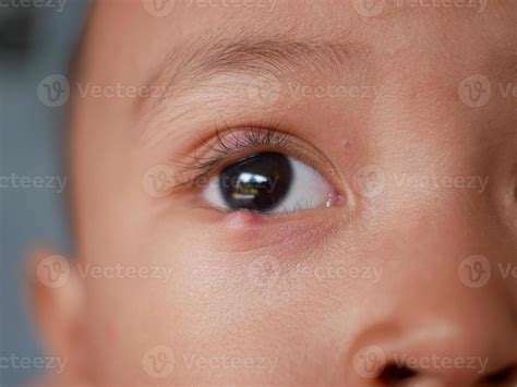 red bumps  toddler eyelid  jenenge blog