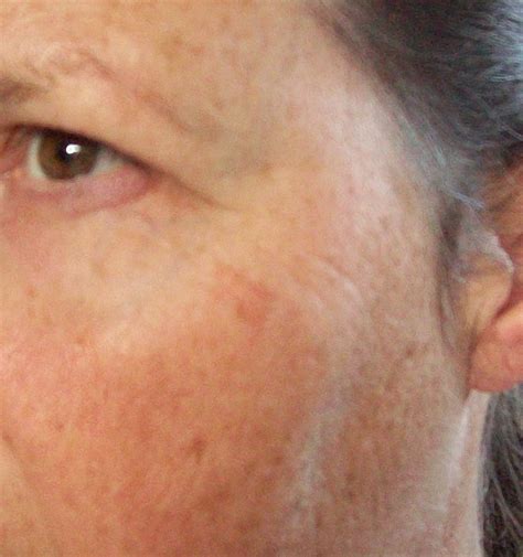 shingles face - pictures, photos