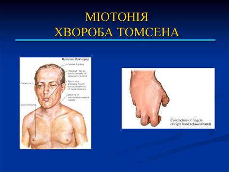 Міопатії. Невральні аміотрофії. Міотонія Томпсона - online presentation