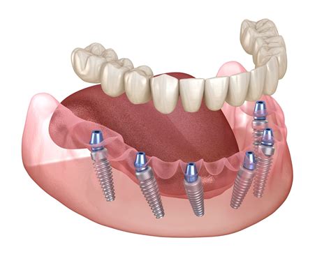 Understanding The All On 4 Procedure: Step-By-Step Breakdown