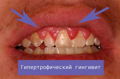 Гіпертрофічний гінгівіт: причини, симптоми, лікування, ознака набряклої ...