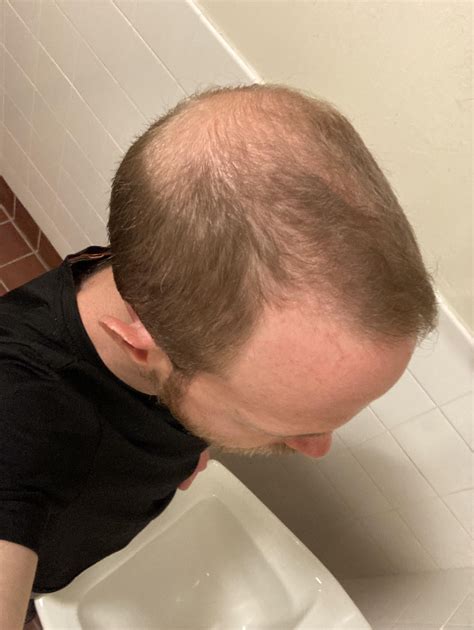 Will I look better bald? Big forehead warning! : r/bald