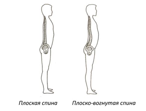 Плоская спина: причины, признаки, лечение, фото